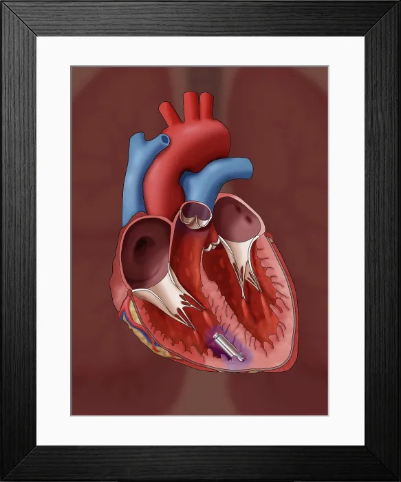 Framed Print : Leadless Pacemaker, Illustration Framed Print : Leadless Pacemaker, Illustration