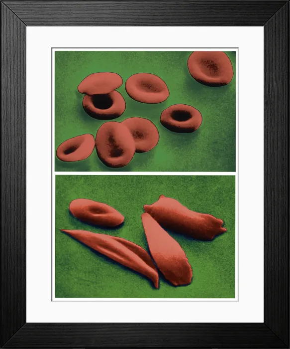 Framed Print : Normal RBCs and Sickle-Cell Anemia, scanning electron micrograph Framed Print : Normal RBCs and Sickle-Cell Anemia, scanning electron micrograph