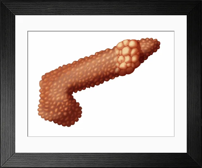 Framed Print : Pancreatic Cancer, Illustration Framed Print : Pancreatic Cancer, Illustration