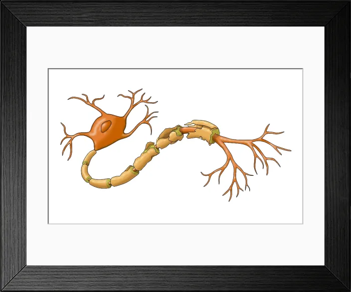 Framed Print : Demyelination Framed Print : Demyelination