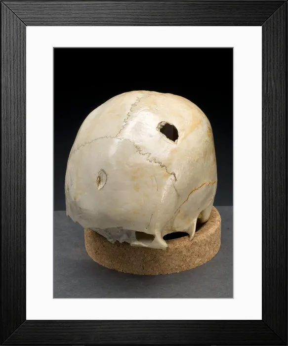 Framed Print : Blunt Force Hammer Trauma to Skull, 1950's