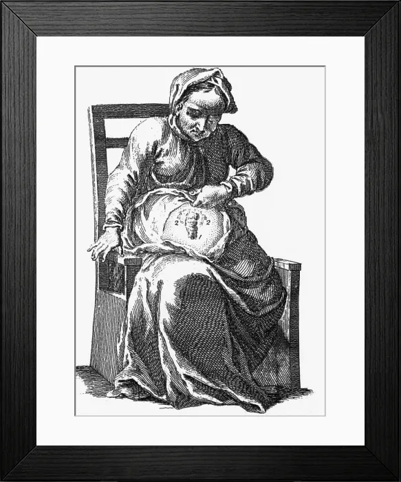 Framed Print : Intestinal Fistula Illustration