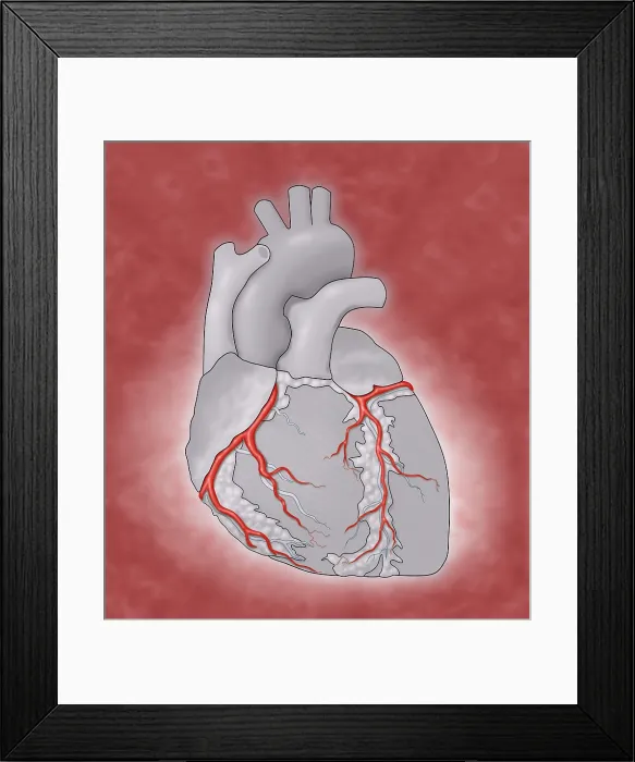 Framed Print : Coronary Arteries, Illustration Framed Print : Coronary Arteries, Illustration