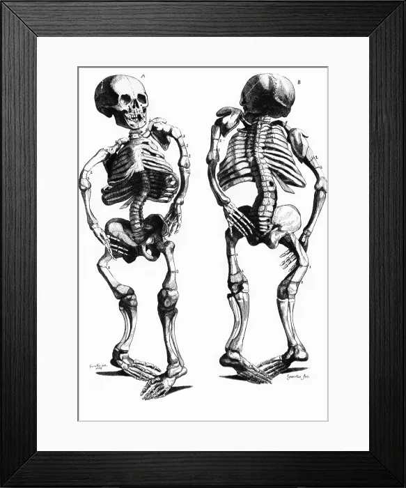 Framed Print : Malformed Skeletons