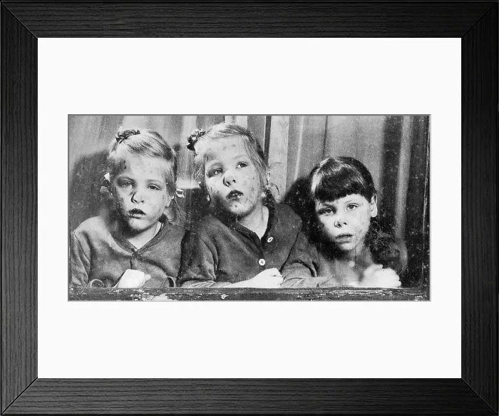 Framed Print : Measles, 1949 Framed Print : Measles, 1949