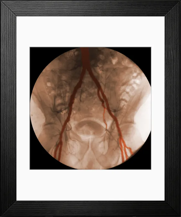 Framed Print : Angiogram of Iliac Arteries Framed Print : Angiogram of Iliac Arteries