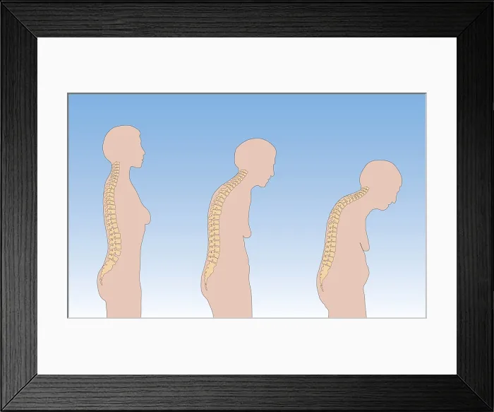 Framed Print : Progression of Osteoporosis Framed Print : Progression of Osteoporosis