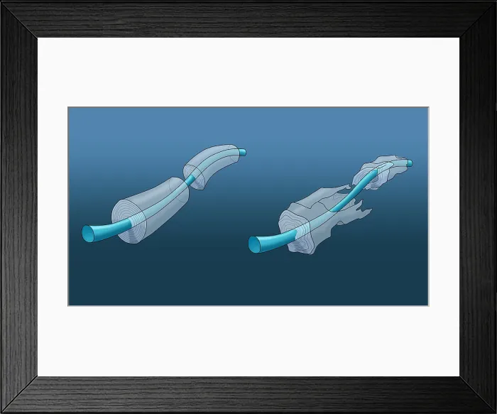 Framed Print : Demyelination Framed Print : Demyelination