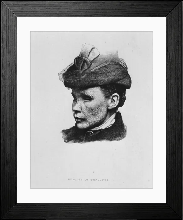 Framed Print : Small Pox Victim Framed Print : Small Pox Victim