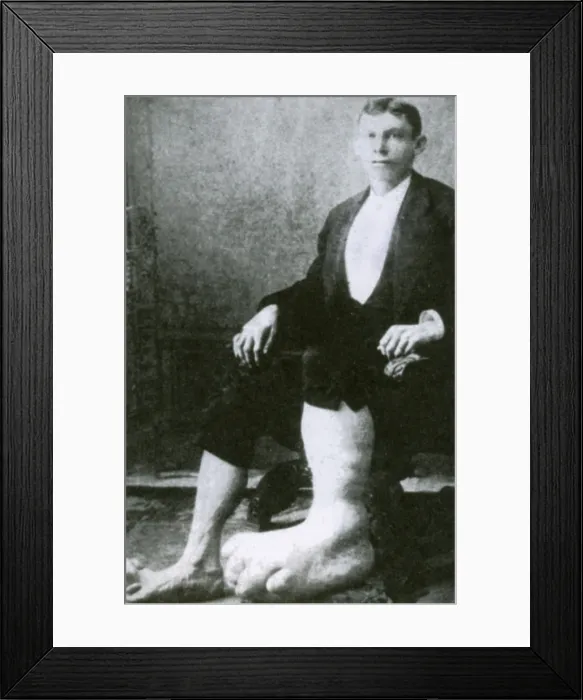 Framed Print : Eugene Berry, Ohio Big Foot Boy Framed Print : Eugene Berry, Ohio Big Foot Boy