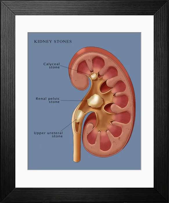 Framed Print : Kidney Stones, Illustration Framed Print : Kidney Stones, Illustration