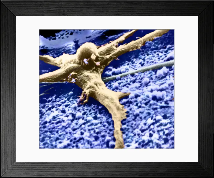 Framed Print : Malignant cancer cell Framed Print : Malignant cancer cell