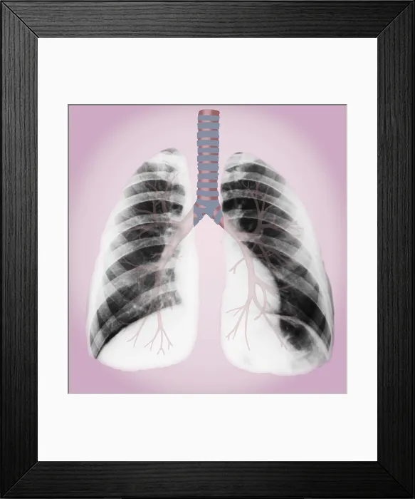 Framed Print : Normal lungs Framed Print : Normal lungs