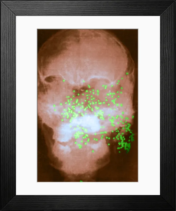 Framed Print : Forensic X-Ray of Murder Victim