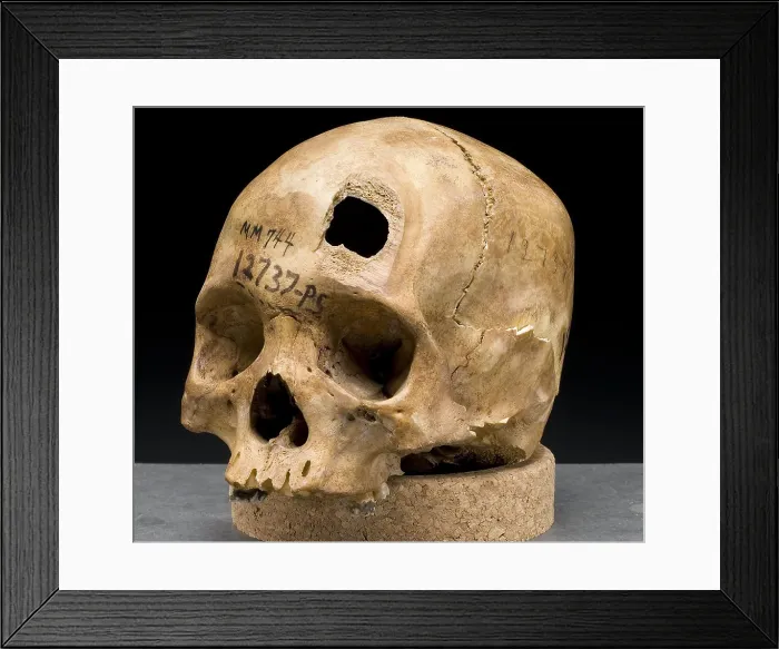 Framed Print : Sword Blade Trauma, 1903