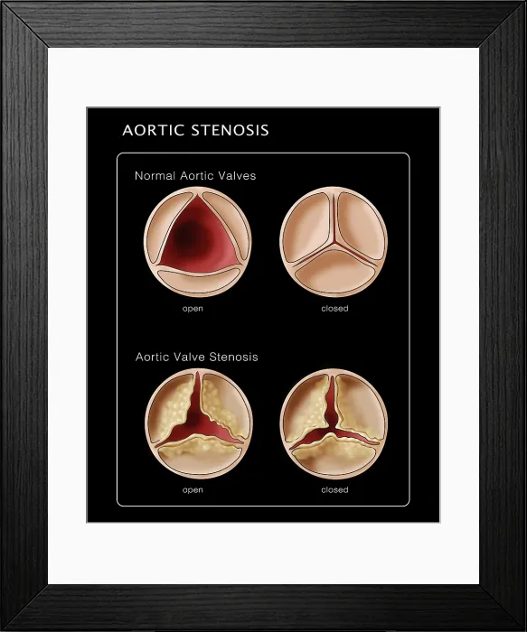 Framed Print : Aortic Valve, Normal & Stenosis, Illustration Framed Print : Aortic Valve, Normal & Stenosis, Illustration
