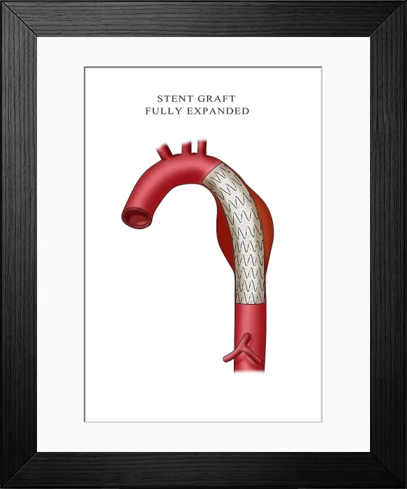 Framed Print : Aortic Stent Graft, Illustration Framed Print : Aortic Stent Graft, Illustration