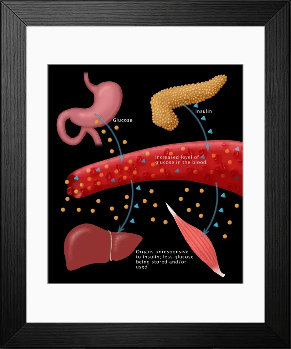 Framed Print : Type II diabetes microbiology diagram of insulin, glucose, blood vessels, pancreas, stomach, medical illustration Framed Print : Type II diabetes microbiology diagram of insulin, glucose, blood vessels, pancreas, stomach, medical illustration