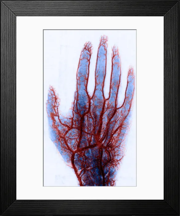 Framed Print : X-ray of Blood Vessels