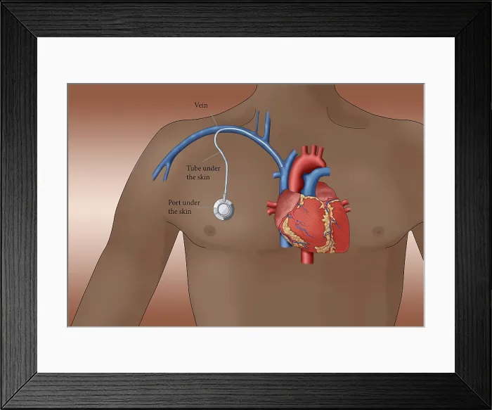 Framed Print : Venous Access Port, Illustration Framed Print : Venous Access Port, Illustration