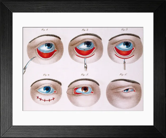 Framed Print : Surgery to Correct Ptosis, 1830 Framed Print : Surgery to Correct Ptosis, 1830