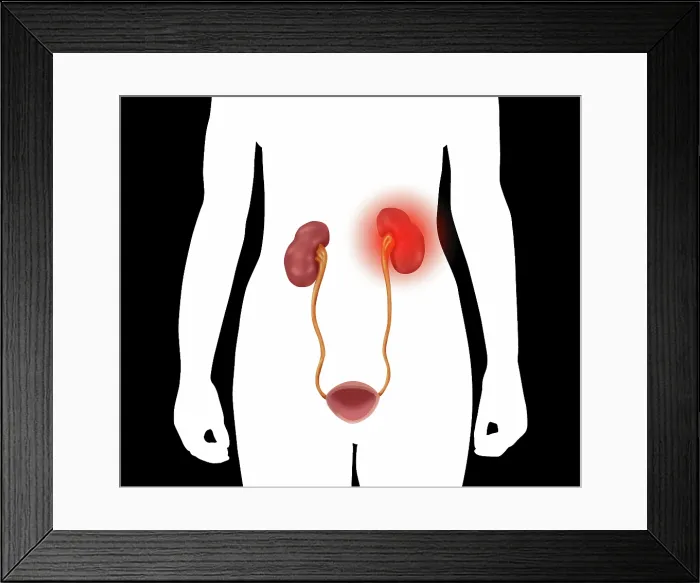 Framed Print : Kidney Pain, Illustration