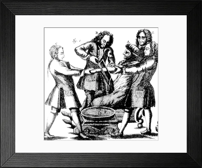 Framed Print : Amputation, 1719 Framed Print : Amputation, 1719