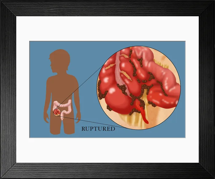 Framed Print : Ruptured Appendix Framed Print : Ruptured Appendix