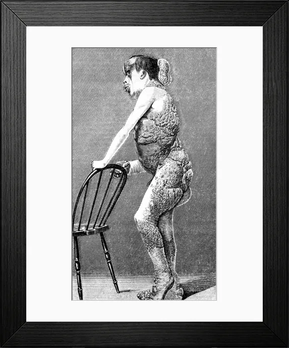 Framed Print : Joseph Merrick, The Elephant Man Framed Print : Joseph Merrick, The Elephant Man