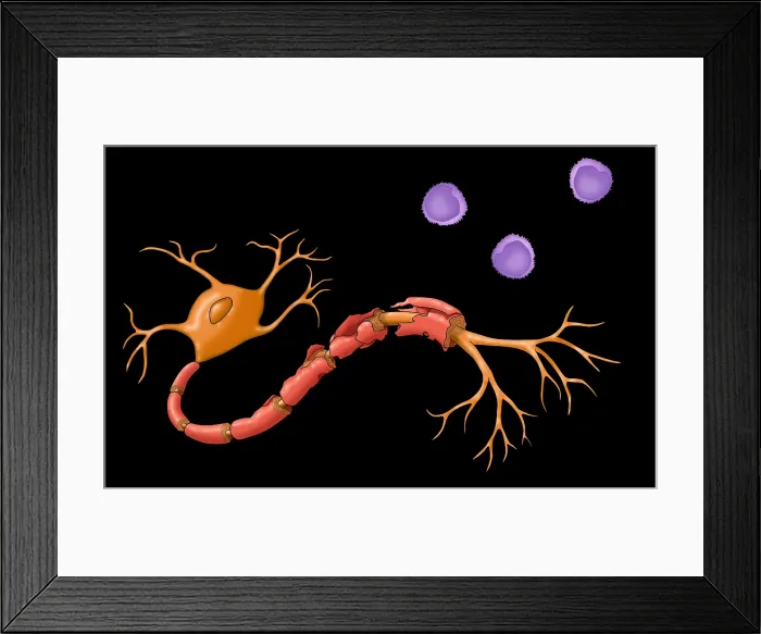 Framed Print : Multiple Sclerosis Framed Print : Multiple Sclerosis