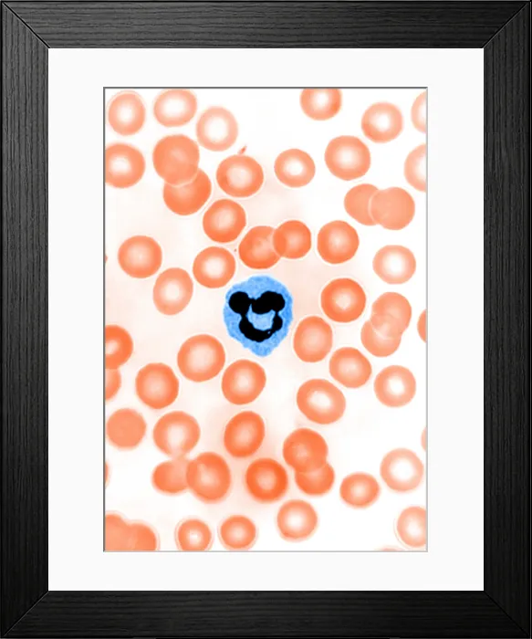 Framed Print : Genetics, Inactive X Chromosome, Drumstick, light micrograph Framed Print : Genetics, Inactive X Chromosome, Drumstick, light micrograph