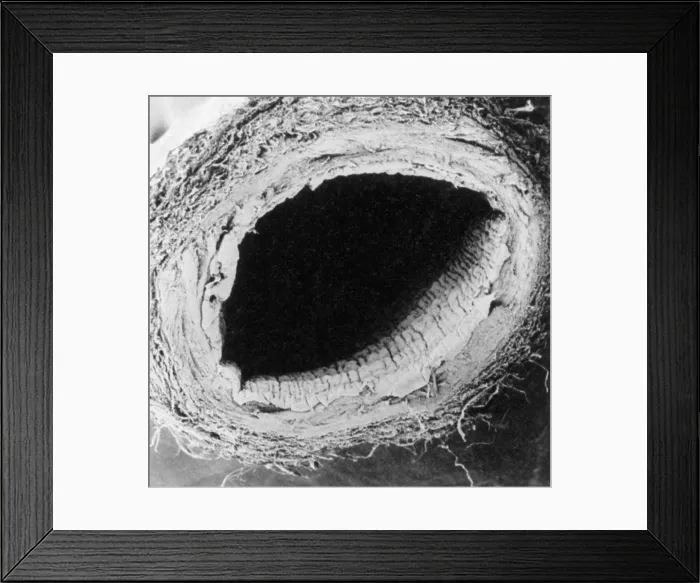 Framed Print : Healthy Vein, under a microscope (SEM) Framed Print : Healthy Vein, under a microscope (SEM)