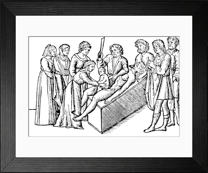 Framed Print : Caesarean Section, 16th Century Framed Print : Caesarean Section, 16th Century
