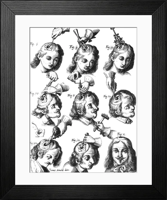 Framed Print : Trepanning, 1666 Framed Print : Trepanning, 1666