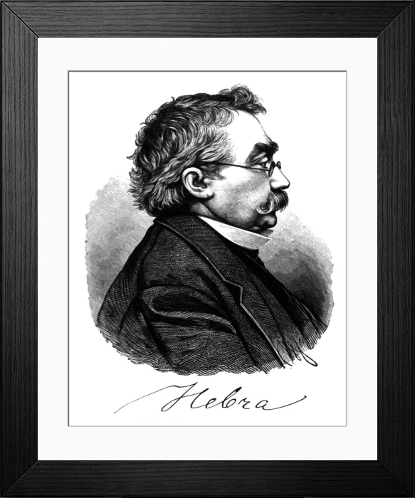 Framed Print : Ferdinand Ritter von Hebra, German Dermatologist Framed Print : Ferdinand Ritter von Hebra, German Dermatologist