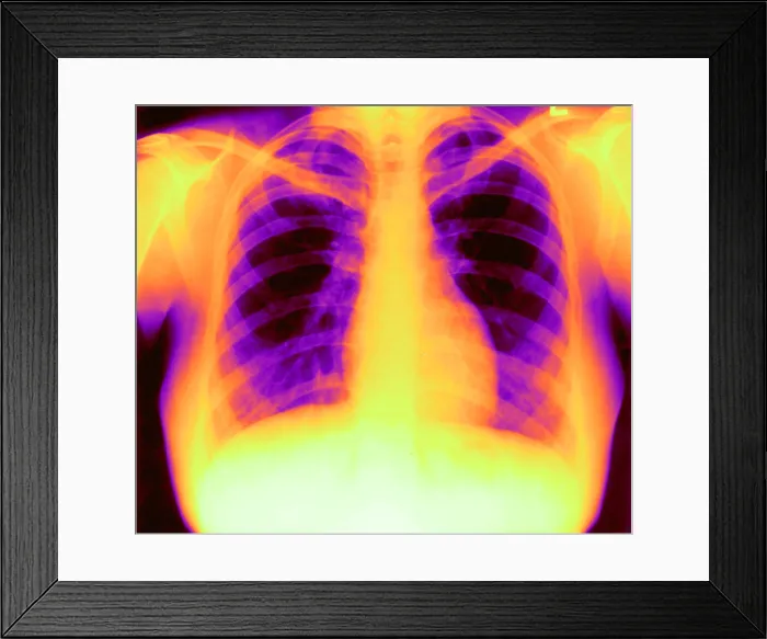Framed Print : X-ray of Heart and Lungs Framed Print : X-ray of Heart and Lungs