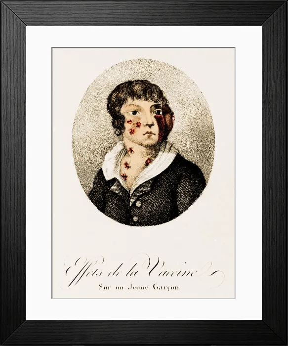Framed Print : Development of Smallpox after Vaccination, 1807 Framed Print : Development of Smallpox after Vaccination, 1807