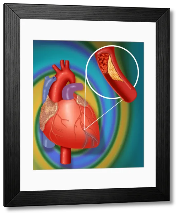Framed Print : Heart Attack Showing Blood Clot Framed Print : Heart Attack Showing Blood Clot