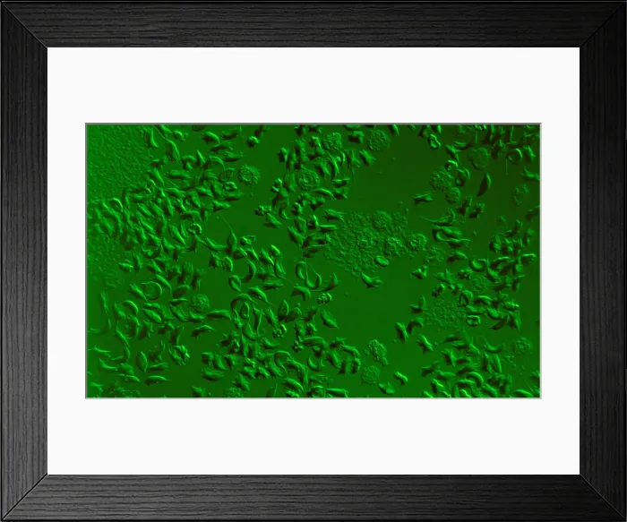 Framed Print : Sickle Cell Anemia