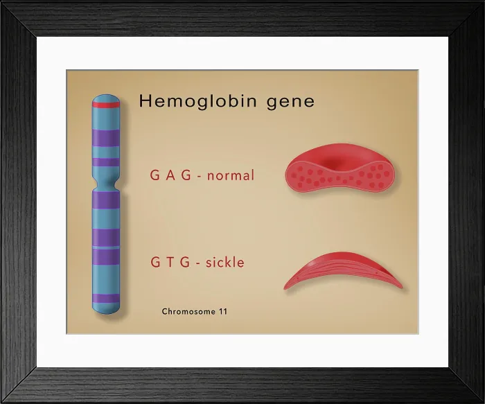 Framed Print : Comparison of hemoglobin in a sickle cell (sickle cell anemia disease) and a normal blood cell, it also illustrates the genetics of chromosome 11