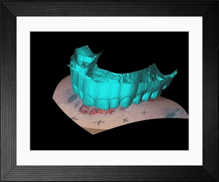 Framed Print : Computer Reconstruction of Bite Mark Framed Print : Computer Reconstruction of Bite Mark