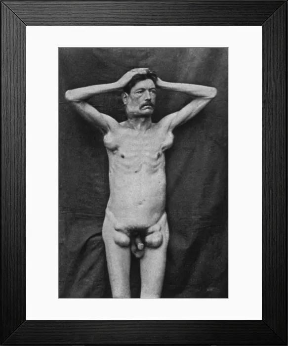 Framed Print : Hodgkin's Disease, 1892 Framed Print : Hodgkin's Disease, 1892