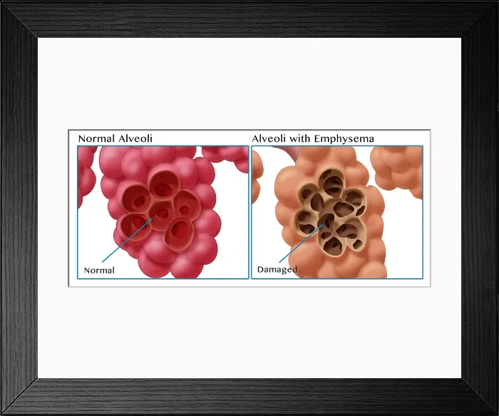 Framed Print : Healthy vs. Emphysematous Alveoli Framed Print : Healthy vs. Emphysematous Alveoli