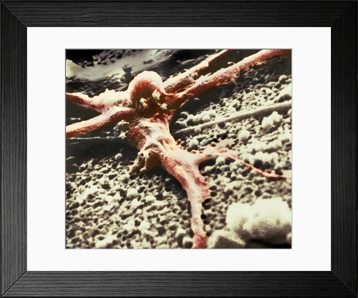 Framed Print : Malignant cancer cell Framed Print : Malignant cancer cell