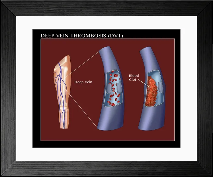 Framed Print : Deep Vein Thrombosis, thrombophlebitis caused by a blood clot in the leg, medical Illustration Framed Print : Deep Vein Thrombosis, thrombophlebitis caused by a blood clot in the leg, medical Illustration