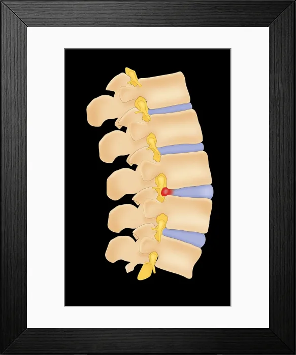Framed Print : Herniated Disk Framed Print : Herniated Disk