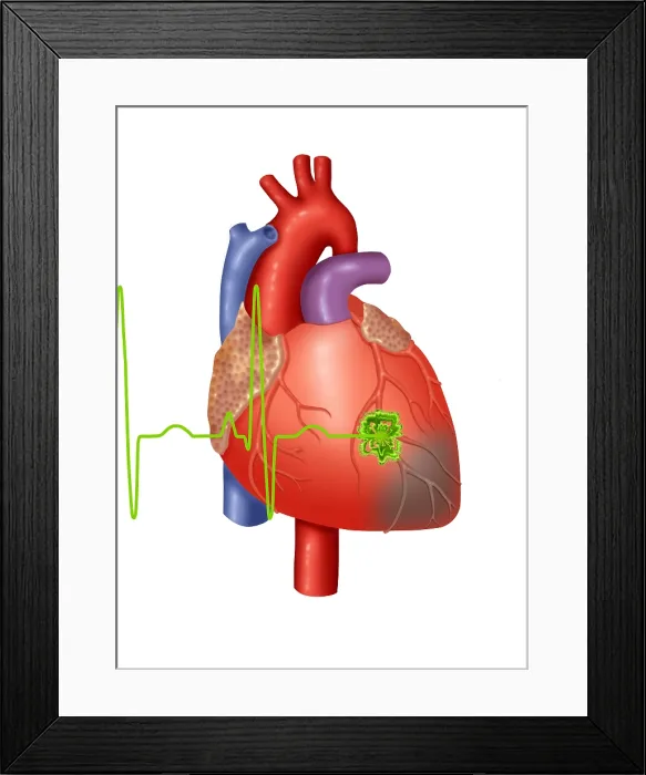 Framed Print : Heart Attack Framed Print : Heart Attack