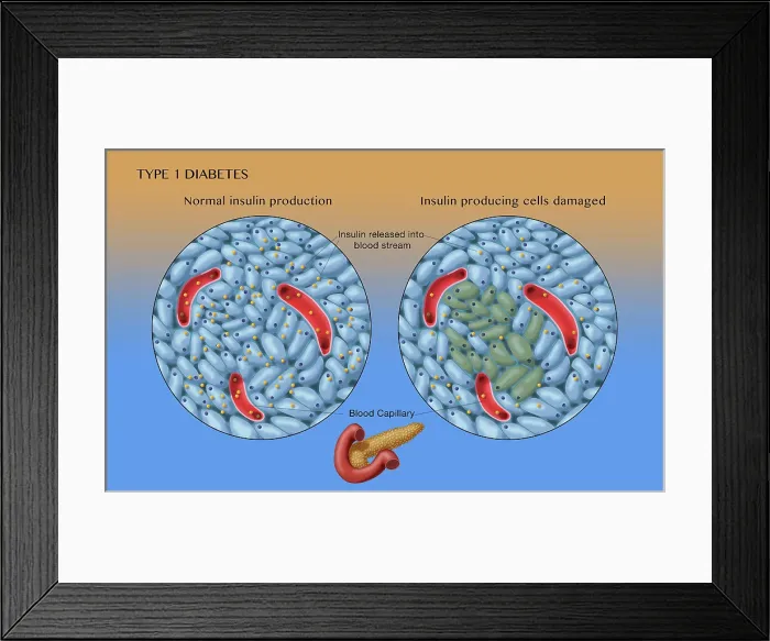 Framed Print : Type 1 Diabetes, Islets of Langerhans