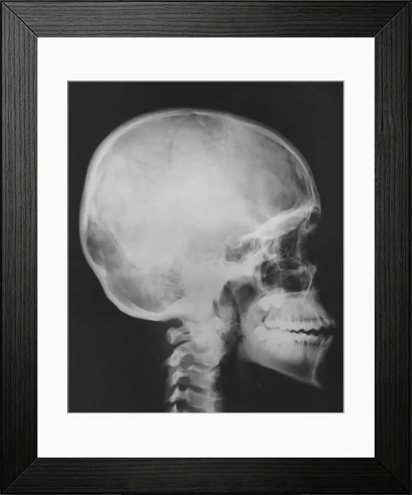 Framed Print : Skull. This X-Ray shows a normal human skull