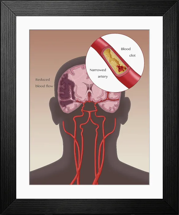 Framed Print : Ischemic Stroke, Illustration Framed Print : Ischemic Stroke, Illustration